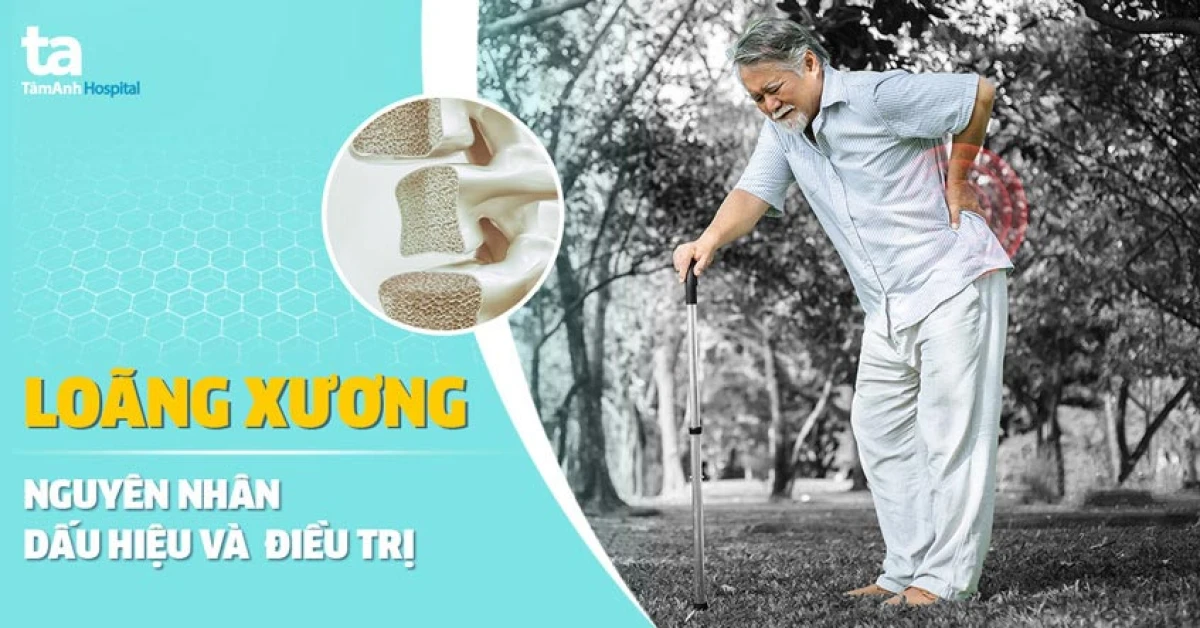 Vận động thể chất thường xuyên giúp tăng mật độ xương