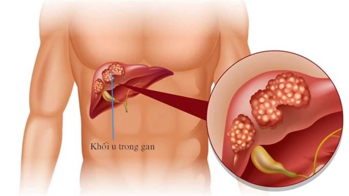 Sự phát triển bất thường của tế bào ung thư trong cơ thể