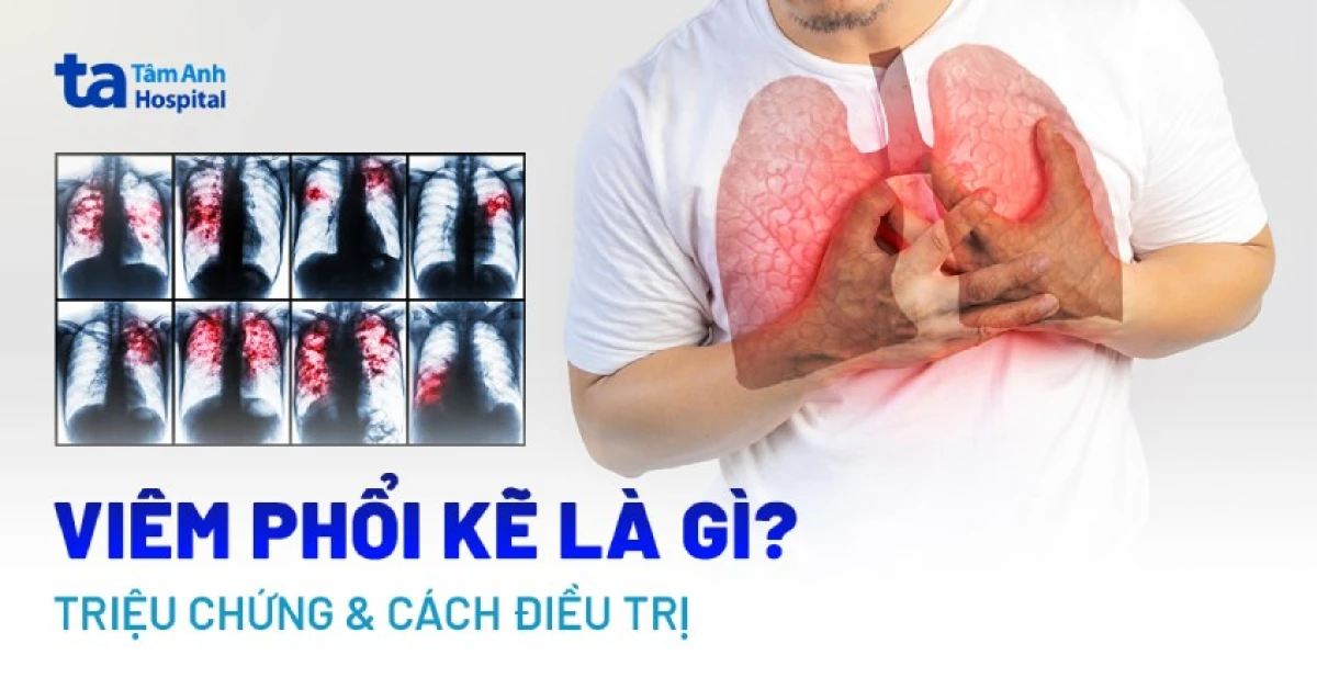 Hình ảnh X-quang bệnh viêm phổi ở phổi người lớn